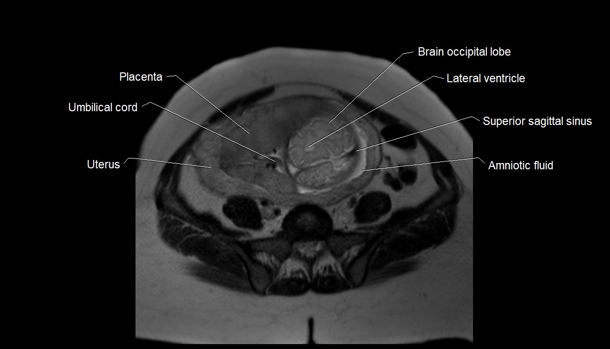 MRI fetal anatomy axial image 26.webp